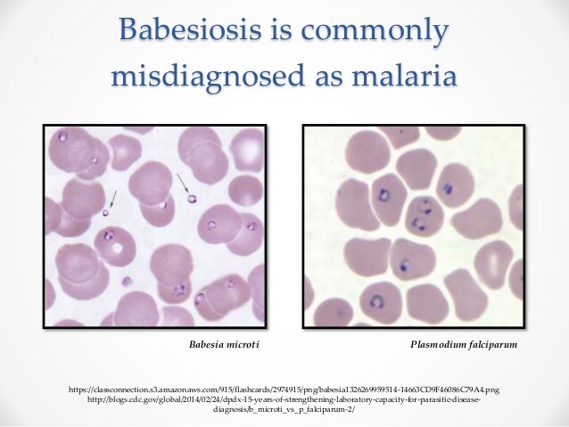 Babesiosis