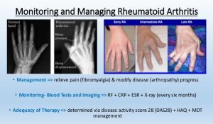 Azulfidine (Sulfasalazine)