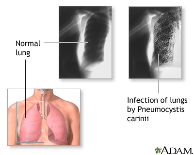 Pneumocystis jiroveci (Pneumocystis carinii) Pneumonia