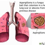 Aspergilloma