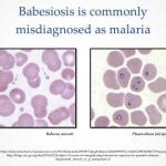 Babesiosis