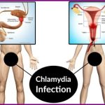 Chlamydia infection