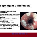 Esophageal candidiasis