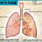 Farmer's lung