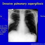 Invasive pulmonary aspergillosis