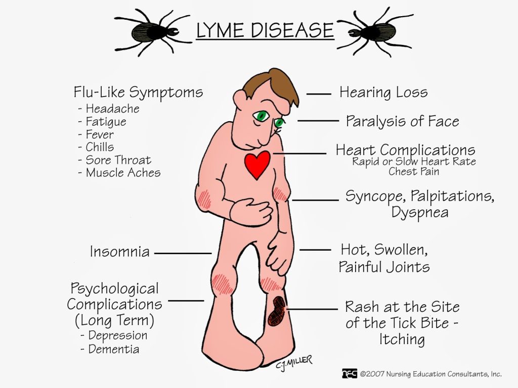 Lyme Disease Bacterial Infections