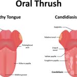 Oral Thrush