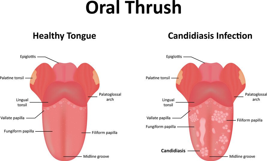 Mouth Ulcers Information