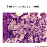 Pneumocystis Carinii