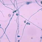 Pseudallescheria boydii infection