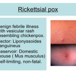 Rickettsialpox