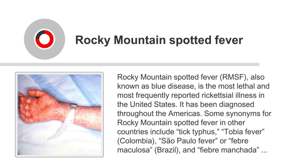 Rocky Mountain Spotted Fever (RMSF) - Bacterial Infections