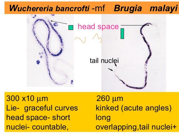 Filariasis (Wuchereria Bancrofti And Brugia Malayi) Filariasis (Wuchereria Bancrofti And Brugia Malayi)