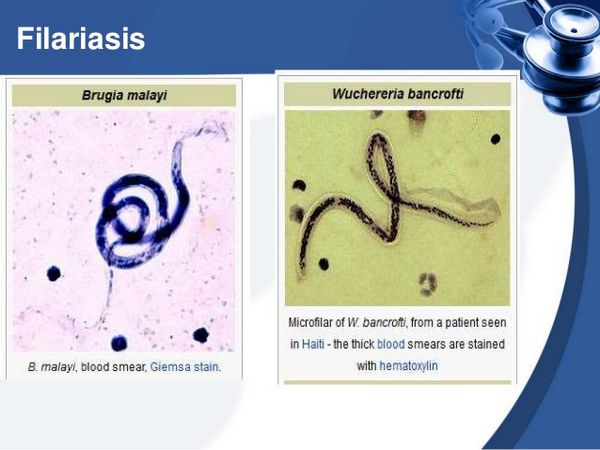 Filariasis (Wuchereria Bancrofti And Brugia Malayi) Filariasis (Wuchereria Bancrofti And Brugia Malayi)