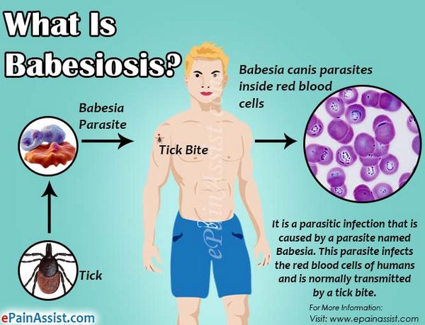 Babesiosis Babesiosis