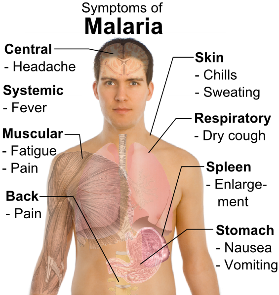 Malaria