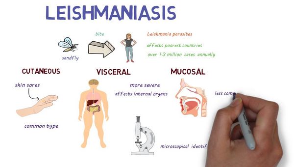 Leishmaniasis