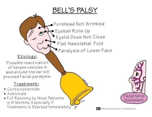 Bell Palsy Treatment