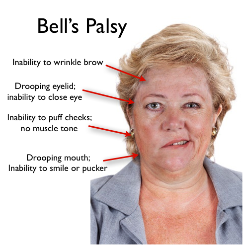 Bell Palsy