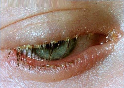 Blepharitis Blepharitis