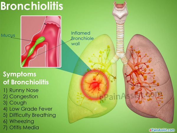 Bronchiolitis