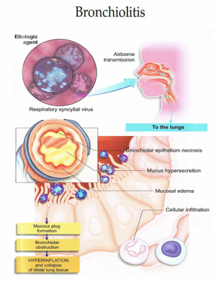 Bronchiolitis