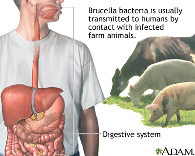 BRUCELLOSIS