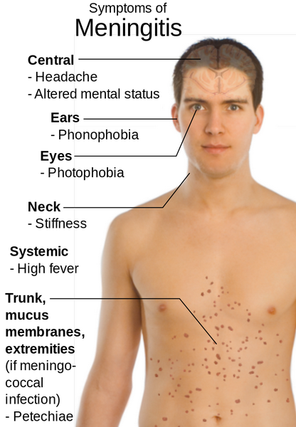 Symptoms of meningitis