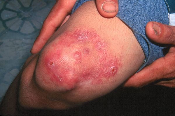 Leprosy