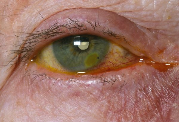 Corneal ulceration