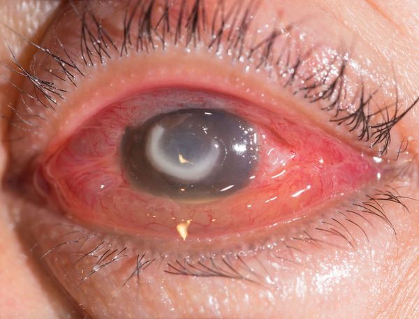 Corneal ulceration