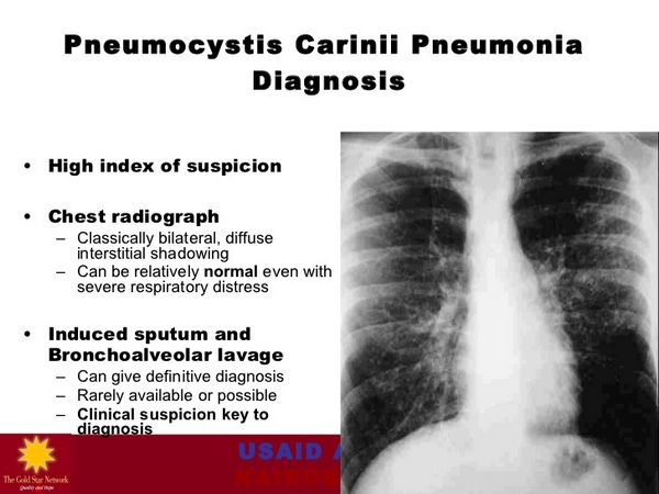 Pneumocystis jiroveci (Pneumocystis carinii) Pneumonia