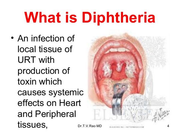Diphtheria Diphtheria
