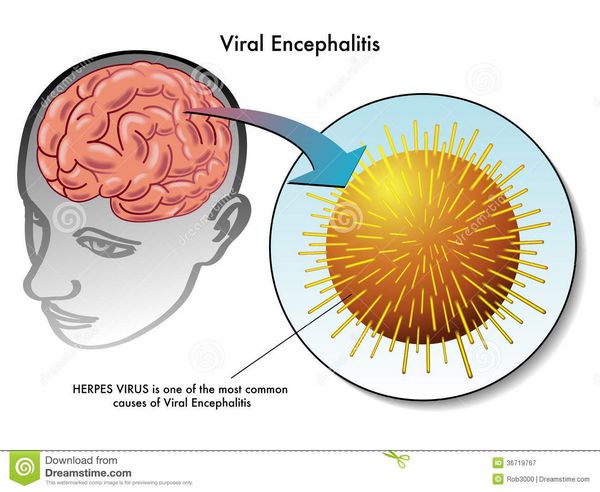 Viral Encephalitis