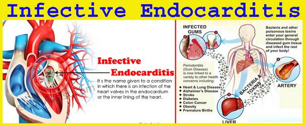 Endocarditis infective