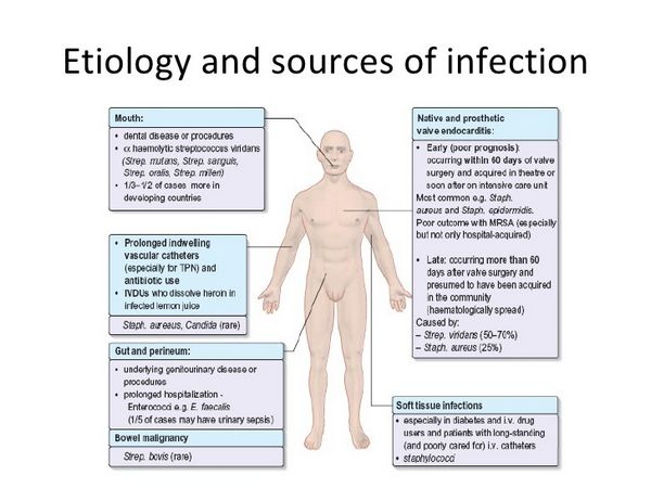 Endocarditis infective