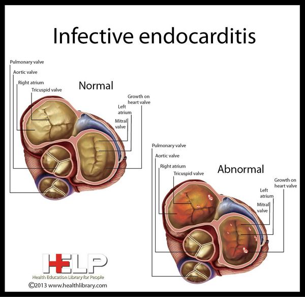Endocarditis infective