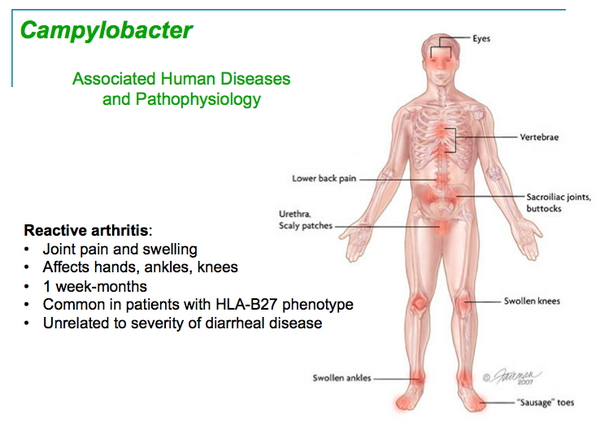 Extraintestinal Campylobacteriosis