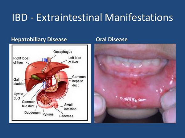 Extraintestinal Disease