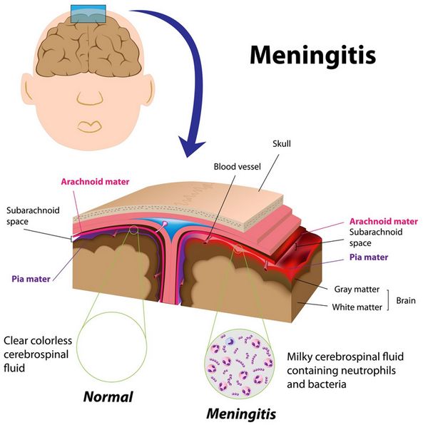 MENINGITIS
