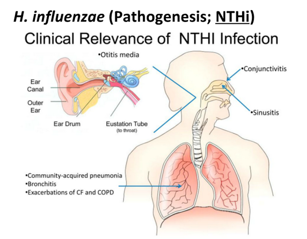 Haemophilus Influenzae: Clinical Syndromes