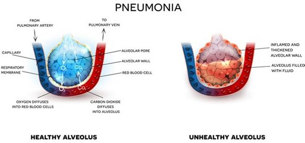 PNEUMONIA