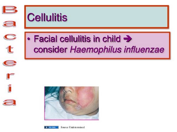 Haemophilus Influenzae CELLULITIS