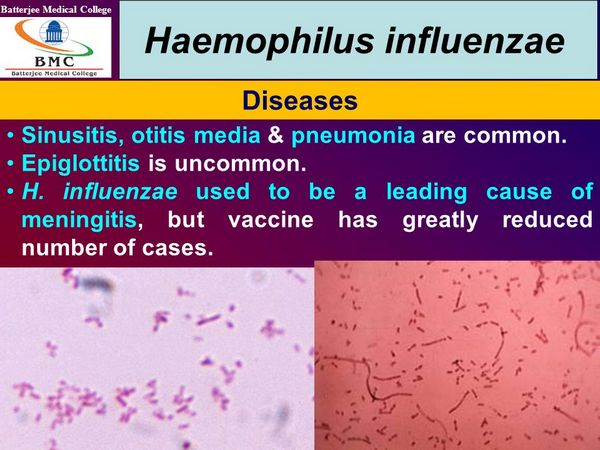 Haemophilus Influenzae OTITIS MEDIA