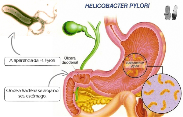 Helicobacter Pylori