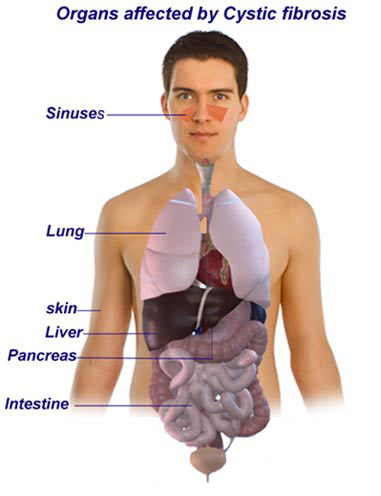 Cystic Fibrosis Cystic Fibrosis