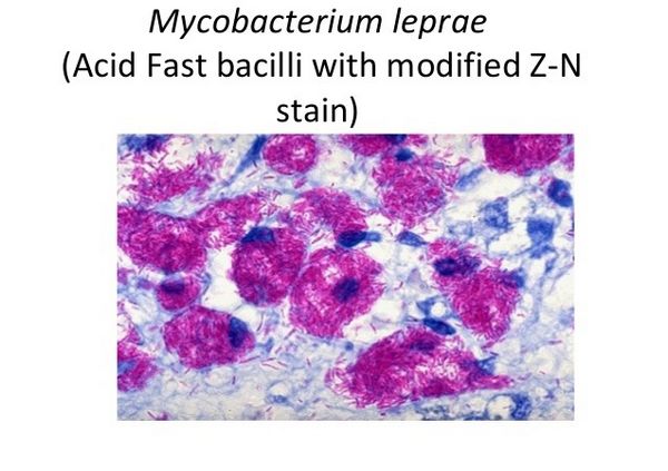 Mycobacterium Leprae