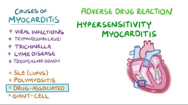 Myocarditis Myocarditis