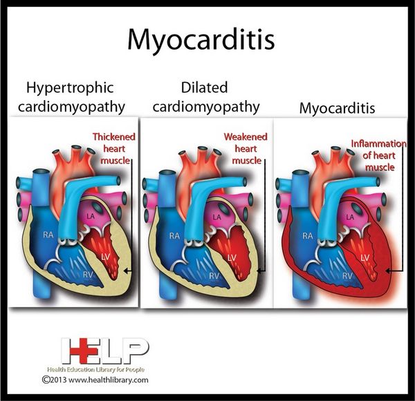 Myocarditis