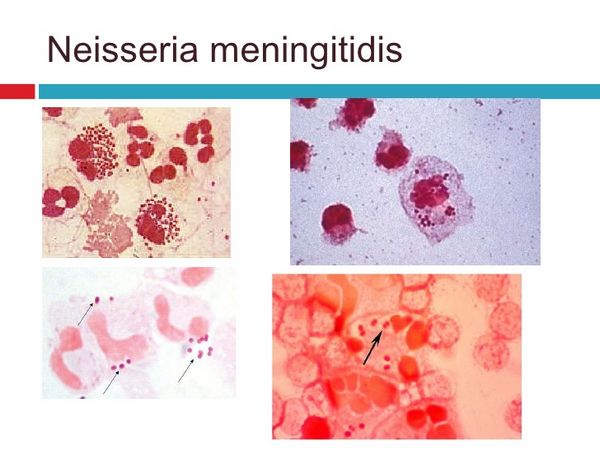 Neisseria Meningitidis